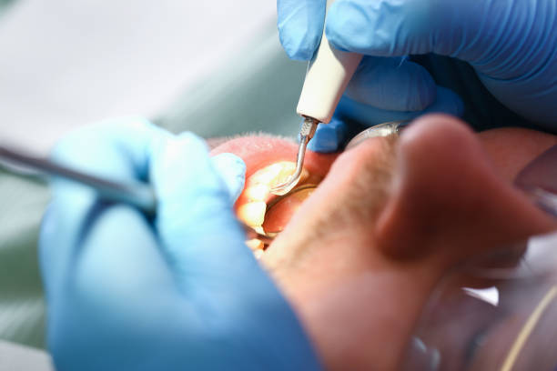 Best Emergency Dental Care for Broken or Chipped Teeth in Elwood, NY